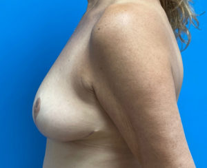 Breast Reduction Before & After Pictures near Fort Lauderdale, FL