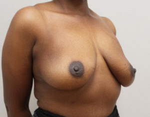 Breast Lift Before and After Pictures Fort Lauderdale, FL