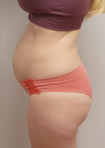 Mini Tummy Tuck Before and After Pictures Fort Lauderdale, FL