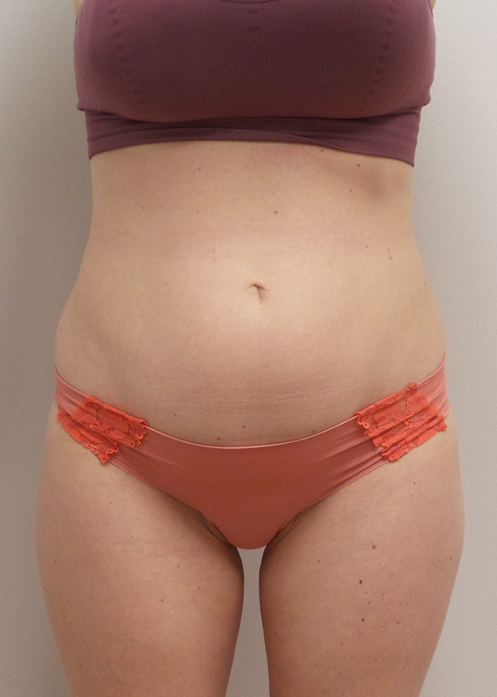 Mini Tummy Tuck Before and After Pictures Fort Lauderdale, FL