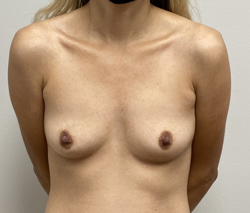 Breast Augmentation Before and After Pictures Fort Lauderdale, FL