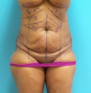 Tummy Tuck Before and After Pictures Fort Lauderdale, FL