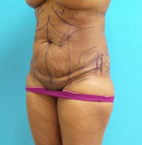 Tummy Tuck Before and After Pictures Fort Lauderdale, FL