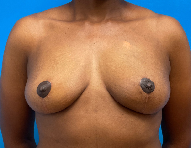 08102021 150700 Breast Lift Before and After Pictures Fort Lauderdale, FL