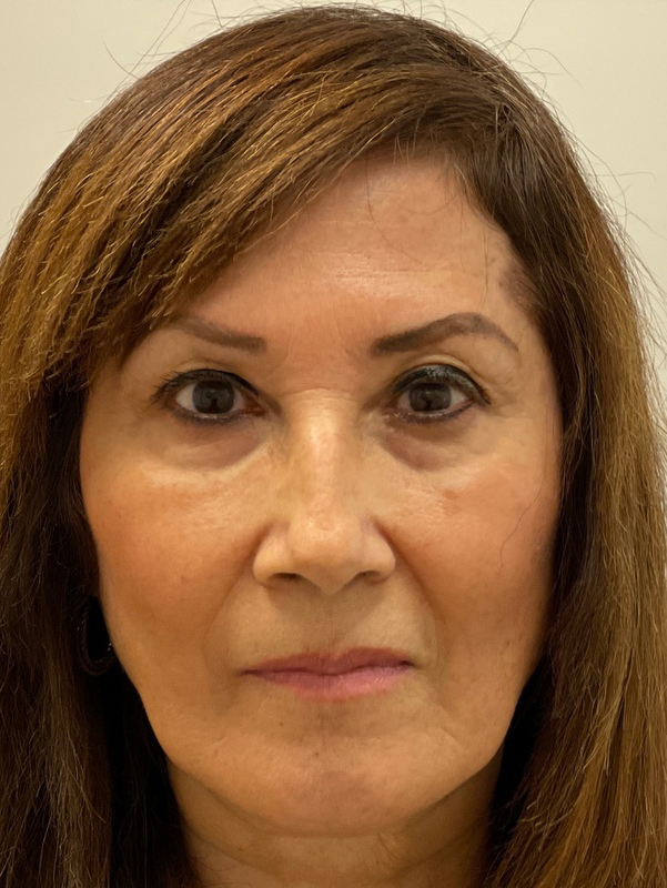 Botox/Dysport Before and After Pictures Fort Lauderdale, FL