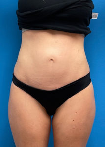 Mini Tummy Tuck Before and After Pictures Fort Lauderdale, FL