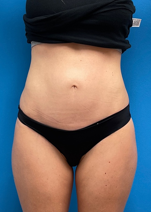 08_23_2021 14_18_05 Mini Tummy Tuck Before and After Pictures Fort Lauderdale, FL