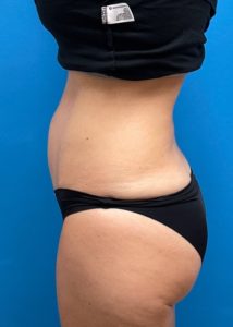 Mini Tummy Tuck Before and After Pictures Fort Lauderdale, FL