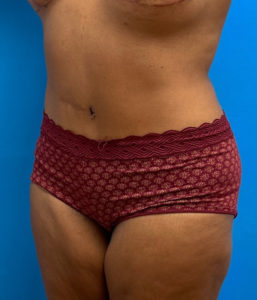 Tummy Tuck Before and After Pictures Fort Lauderdale, FL