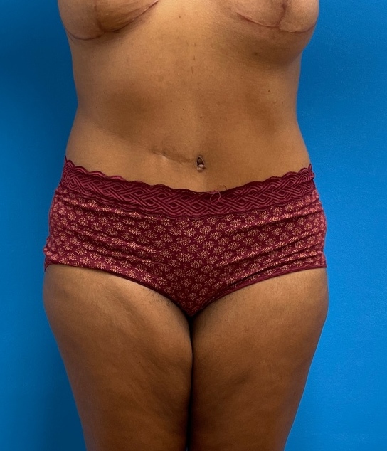 08_30_2021 18_17_52 (5) Tummy Tuck Before and After Pictures Fort Lauderdale, FL