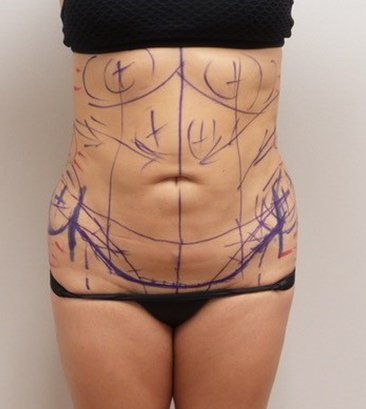 Tummy Tuck Before and After Pictures Fort Lauderdale, FL