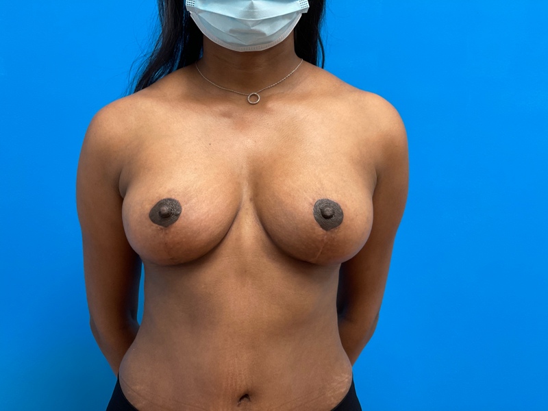 09232021 164000 Breast Lift Before & After Pictures near Fort Lauderdale, FL