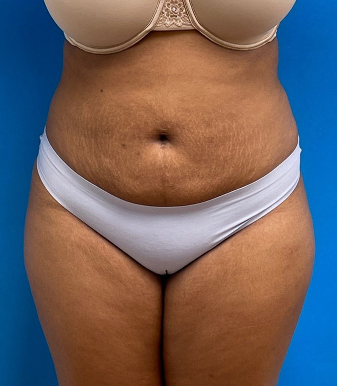 Liposuction with Renuvion Before and After Pictures Fort Lauderdale, FL