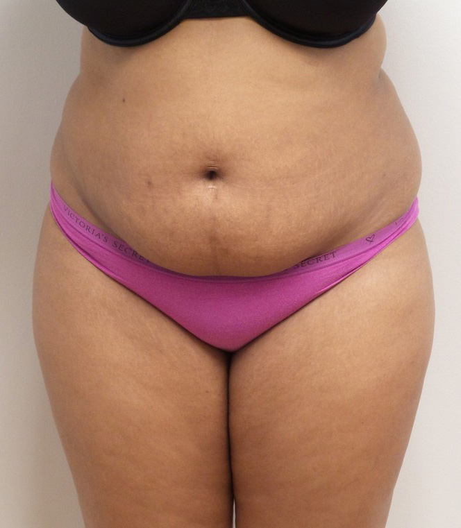 Liposuction with Renuvion Before and After Pictures Fort Lauderdale, FL