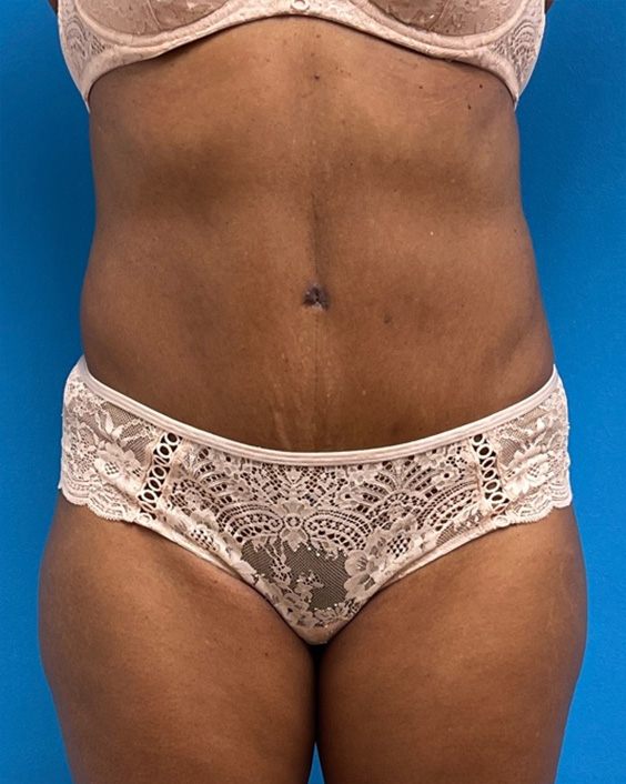 Tummy Tuck Before and After Pictures Fort Lauderdale, FL