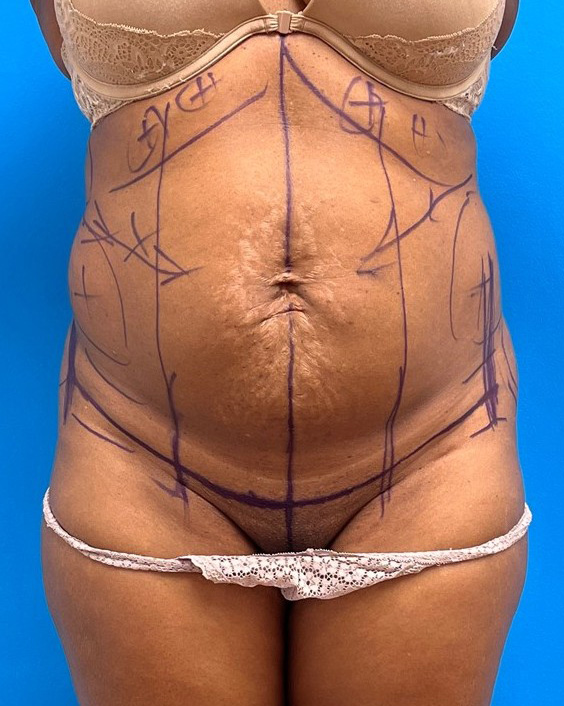 Tummy Tuck Before and After Pictures Fort Lauderdale, FL