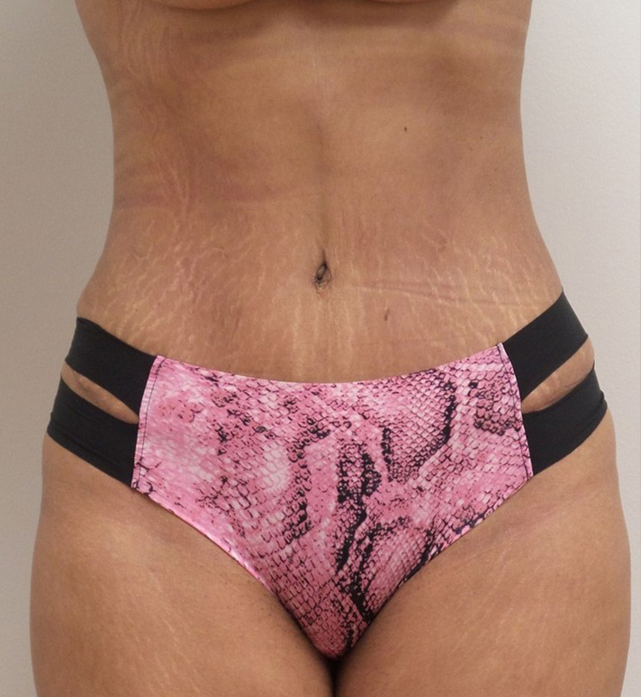 Tummy Tuck Before and After Pictures Fort Lauderdale, FL