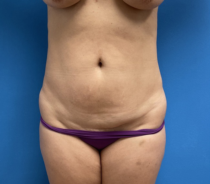 Mini Tummy Tuck Before and After Pictures Fort Lauderdale, FL