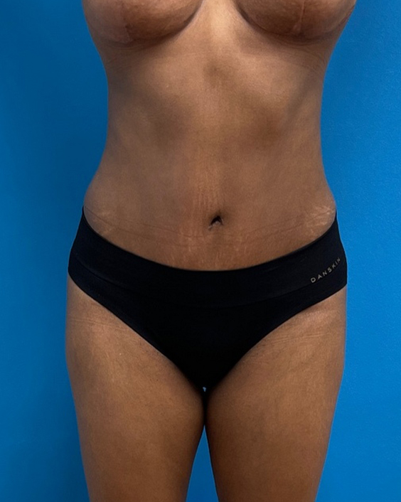 Tummy Tuck Before and After Pictures Fort Lauderdale, FL