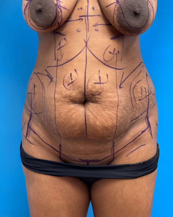 thumb-before -05212021 194900 Tummy Tuck Before and After Pictures Fort Lauderdale, FL