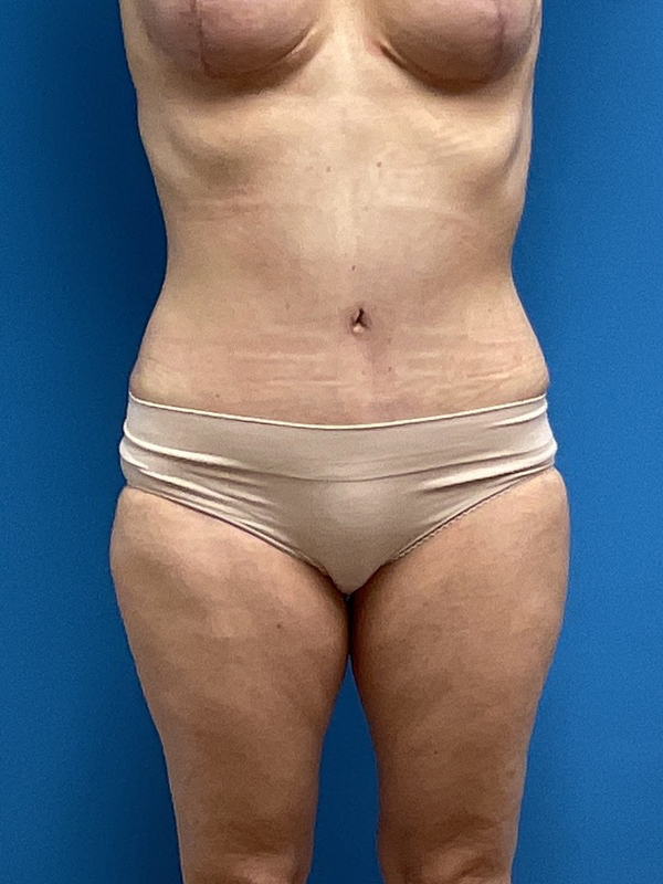 Tummy Tuck Before & After Pictures near Fort Lauderdale, FL