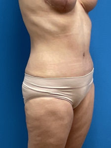 Tummy Tuck Before & After Pictures near Fort Lauderdale, FL