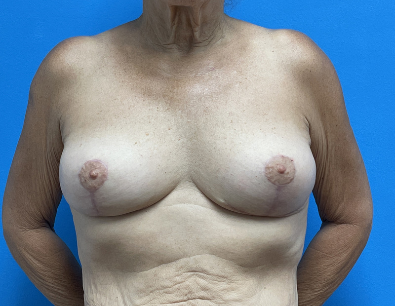 Breast Lift Before & After Pictures near Fort Lauderdale, FL