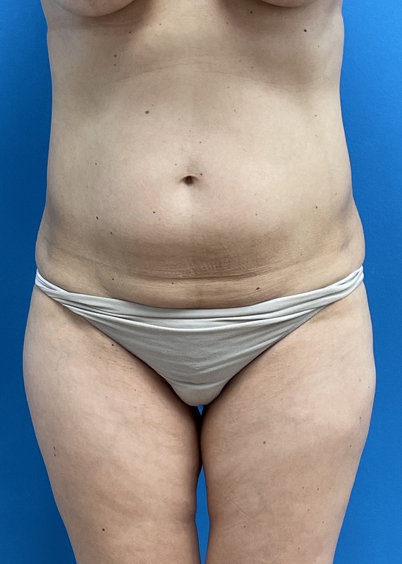 Mini Tummy Tuck Before & After Pictures near Fort Lauderdale, FL