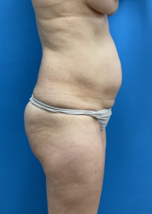 Mini Tummy Tuck Before & After Pictures near Fort Lauderdale, FL