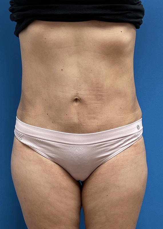 Mini Tummy Tuck Before & After Pictures near Fort Lauderdale, FL