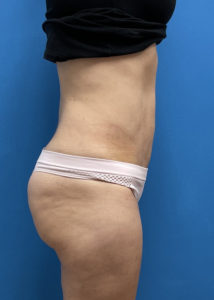 Mini Tummy Tuck Before & After Pictures near Fort Lauderdale, FL