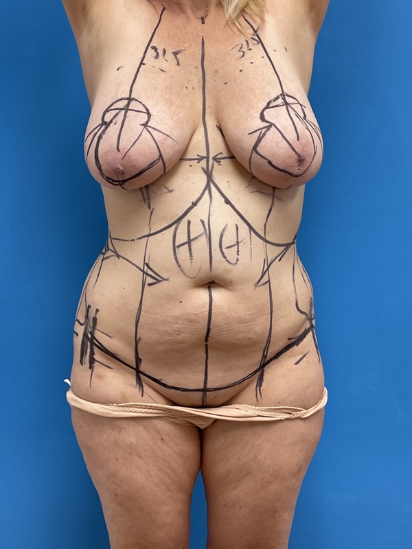 Tummy Tuck Before & After Pictures near Fort Lauderdale, FL