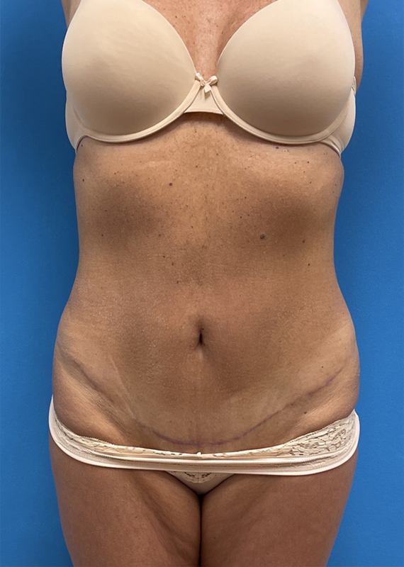 Mini Tummy Tuck Case 15 - after 1 Mini Tummy Tuck Before & After Pictures near Fort Lauderdale, FL