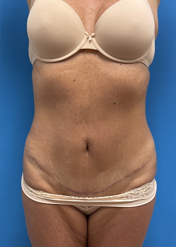 Mini Tummy Tuck Before and After