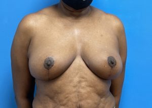 Breast Reduction Before & After Pictures near Fort Lauderdale, FL