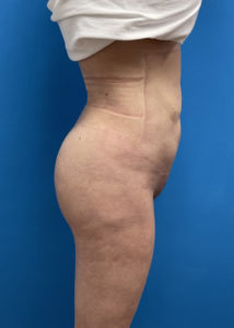 Brazilian Butt Lift Before and After Pictures Fort Lauderdale, FL