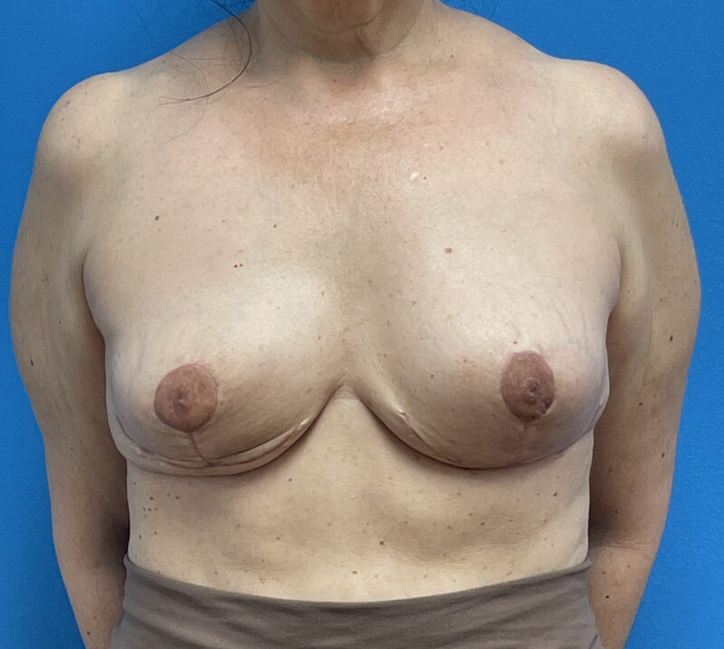 Breast Implant Removal Before & After Pictures near Fort Lauderdale, FL