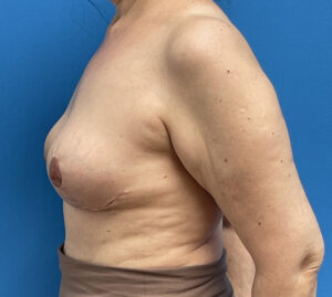 Breast Implant Removal Before & After Pictures near Fort Lauderdale, FL