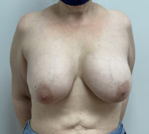 Breast Implant Removal Before & After Pictures near Fort Lauderdale, FL