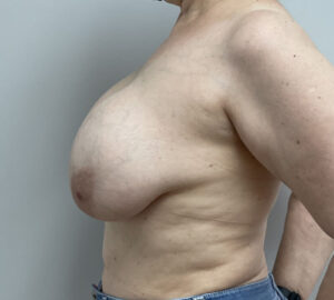 Breast Implant Removal Before & After Pictures near Fort Lauderdale, FL