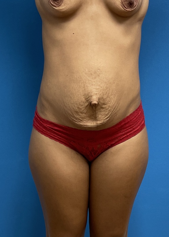 Tummy Tuck Before & After Pictures near Fort Lauderdale, FL