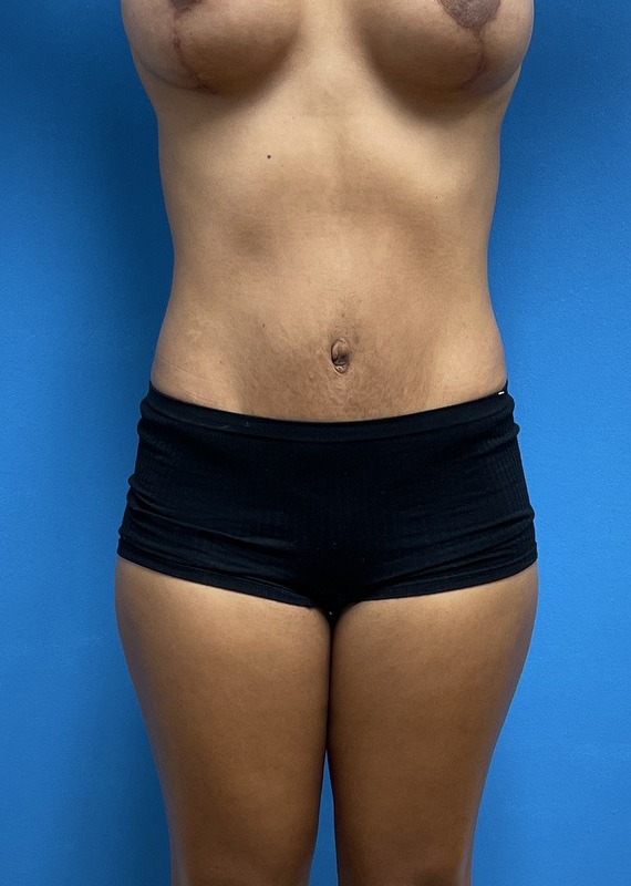 Tummy Tuck Before & After Pictures near Fort Lauderdale, FL