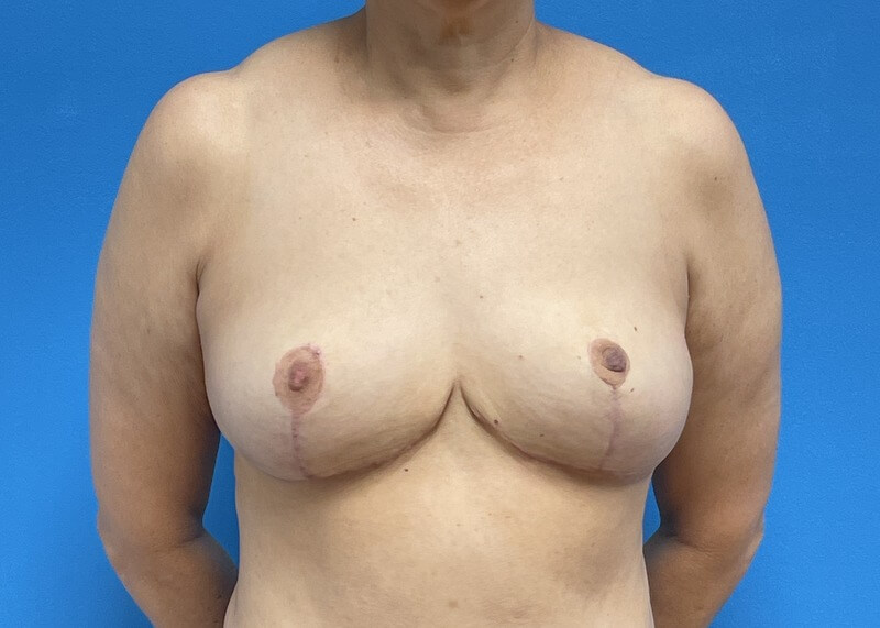 Breast Implant Removal Before & After Pictures near Fort Lauderdale, FL