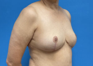 Breast Implant Removal Before & After Pictures near Fort Lauderdale, FL