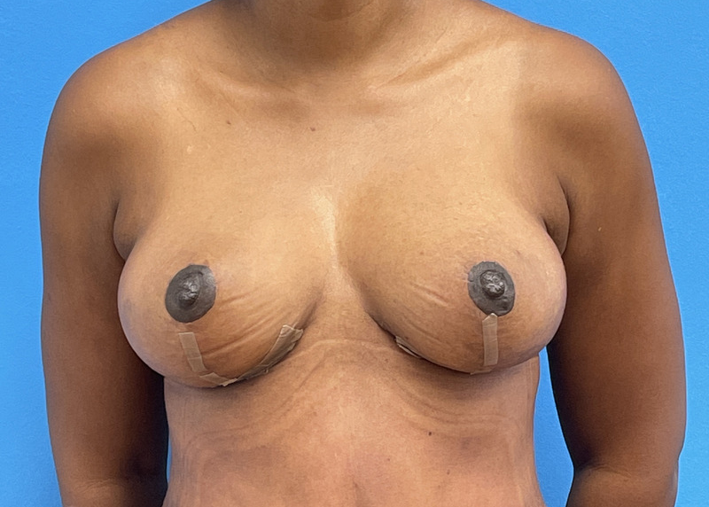 Breast Reduction Before & After Pictures near Fort Lauderdale, FL