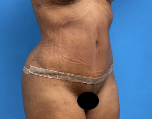 Tummy Tuck Before & After Pictures near Fort Lauderdale, FL