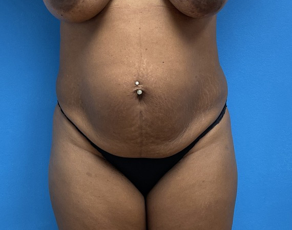 Tummy Tuck Before & After Pictures near Fort Lauderdale, FL