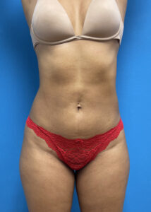 Liposuction with Renuvion Before & After Pictures near Fort Lauderdale, FL