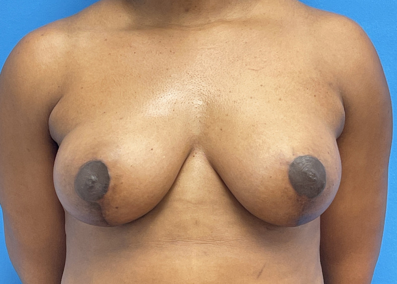 Breast Lift Before & After Pictures near Fort Lauderdale, FL