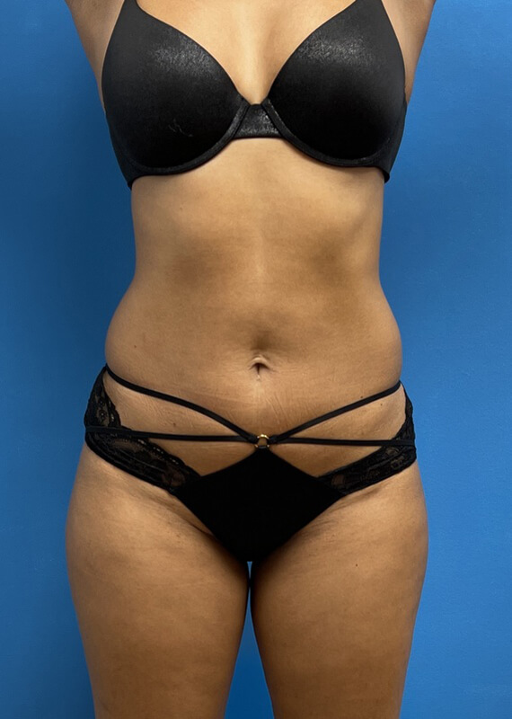 Liposuction with Renuvion Before & After Pictures near Fort Lauderdale, FL